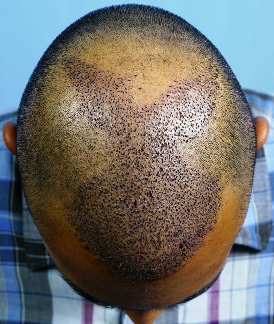 Chest Hair FUE as donor for the Scalp Hair Restoration Questions and